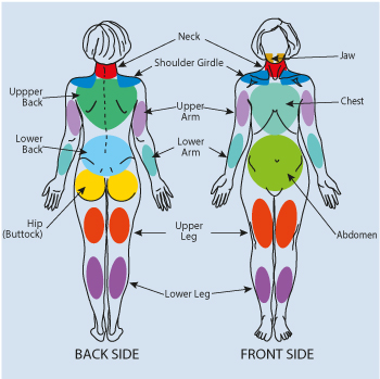 Chart shows a woman with coloured areas highlighting fibromyalgia pain.